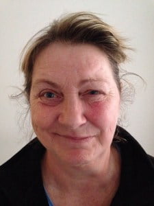 Billede af ubehandlet bells parese