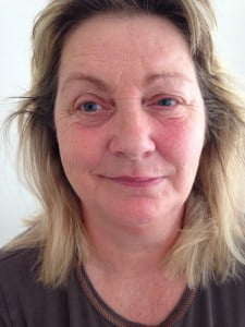 Billlede af ansigt med bells parese efter 2. behandling med akupunktur