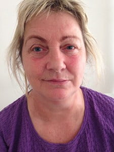 Billlede af ansigt med bells parese efter 3. behandling med akupunktur