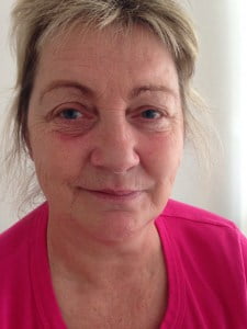 Billlede af ansigt med bells parese efter 4. behandling med akupunktur